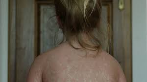 தட்டம்மை தொற்றுm, பள்ளி வளாகம் மூடப்பட்டுள்ளது