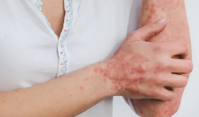 psoriasis 5996424 1280