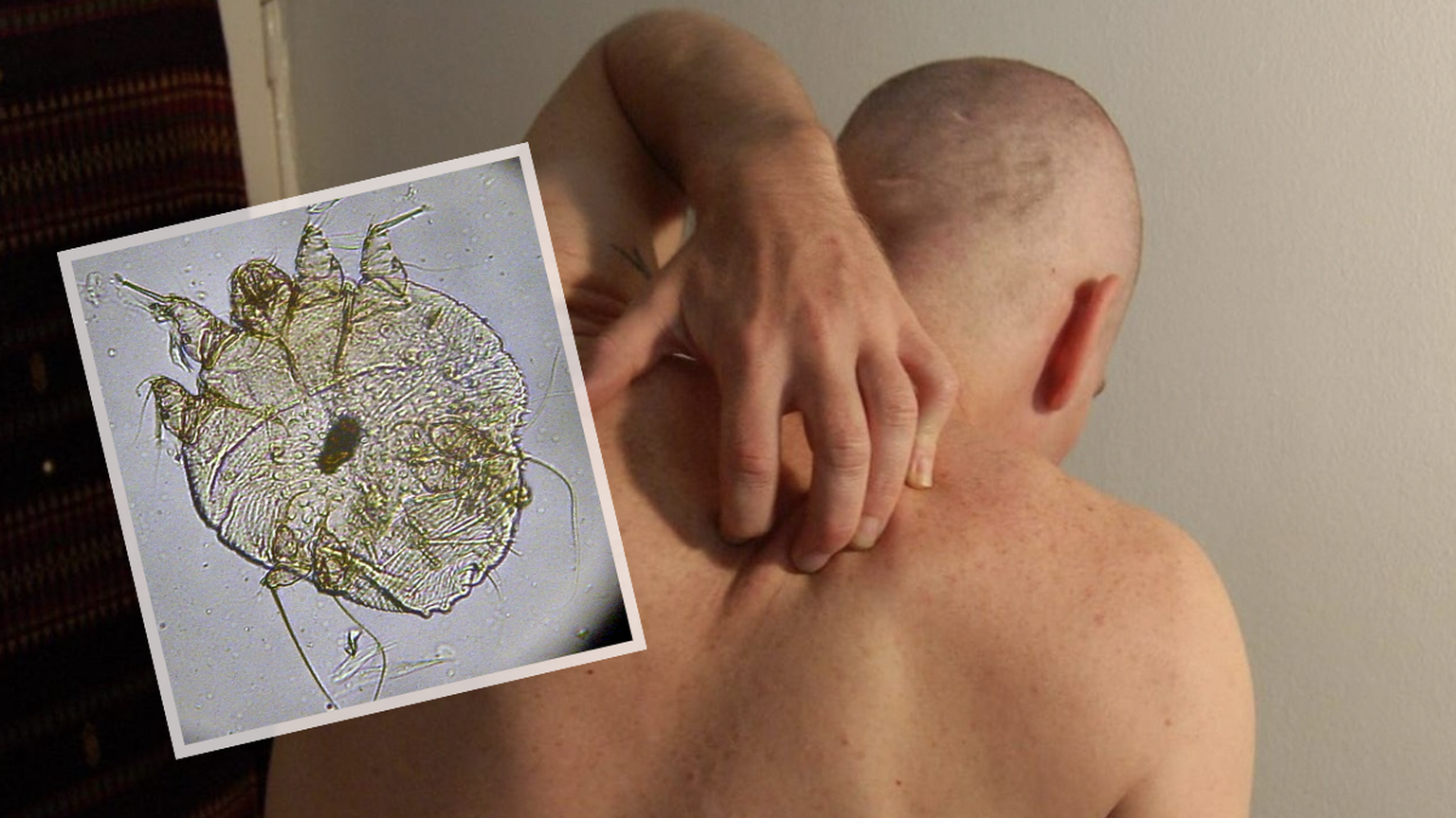 சுவிட்சர்லாந்தில் பரவும் சிரங்கு நோயைக் கட்டுப்படுத்த நடவடிக்கை