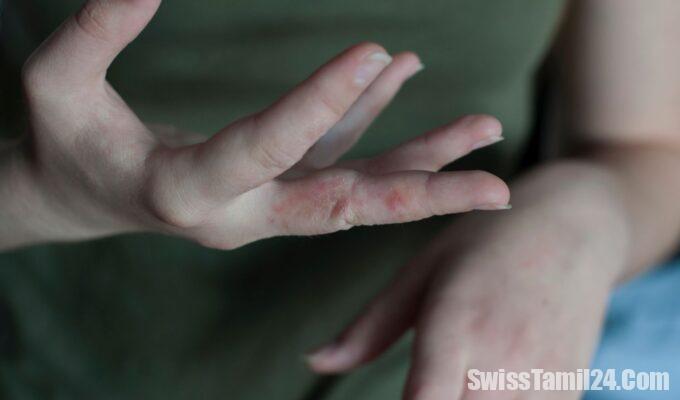 Zurich health authorities consider the scabies epidemic to be over